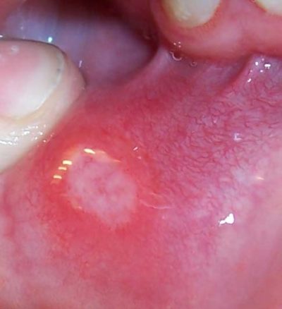 A white based ulcer in the mucous of the mouth